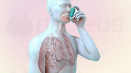 Metered-Dose Inhaler Delivering Medication to Lungs