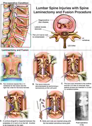 Lumbar Spine Injuries with Spine Laminectomy and Fusion Procedure