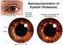 Neovascularization of Eyeball (Rubeosis)