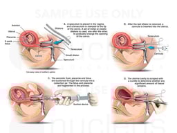 Depiction of Dilatation and Evacuation Abortion Performed at 9 Weeks Gestation