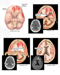 Traumatic Brain Injury