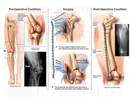 Right Femur Fracture with Surgical Fusion