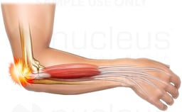 Ulnar Nerve Entrapment