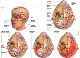 Chronic Progression of Intracranial Infection