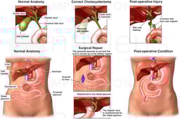 Post-operative Bile Duct Injury with Surgical Repair