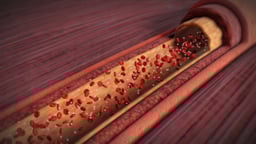 About Your Heart Attack