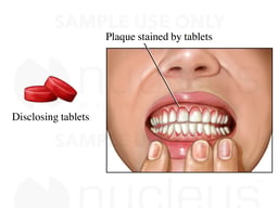 Self-exam for Dental Plaque