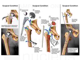 Multiple Surgeries to Repair the Right Hip