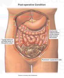 Bowel Puncture / Laceration During Laparoscopic Surgery