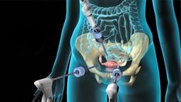 What Happens During a Diagnostic Pelvic Laparoscopy?