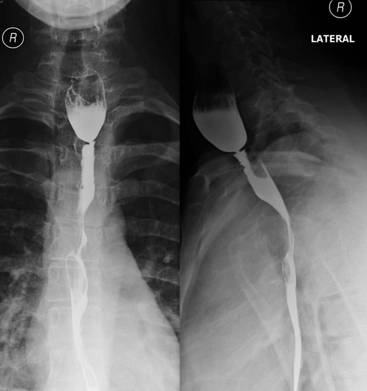 Oesophagus — In a 21 year old girl with new onset dysphagia. What is the likely diagnosis?