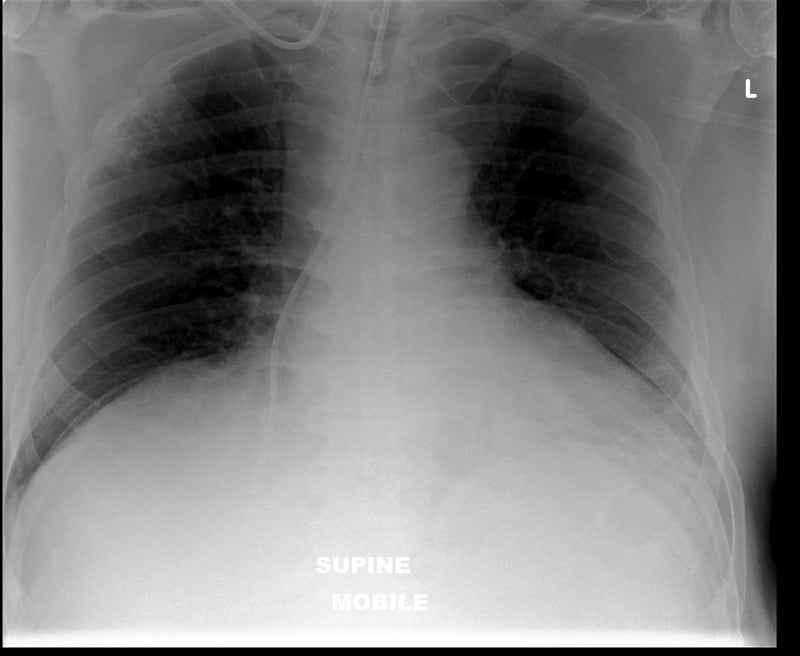 ARDS — What does the radiograph show?