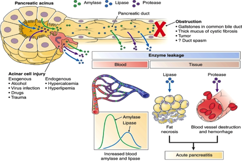 Pancreatitis — MRCS Part B Applied surgical science and critical care