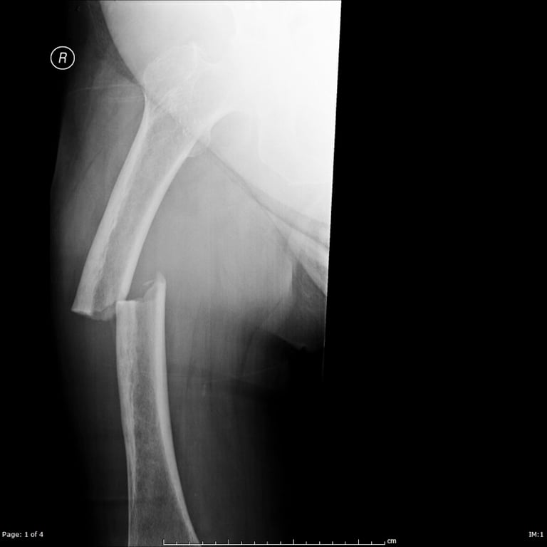 Shock 1 — The patient is stabilised and secondary surgery is performed including radiographs of her 