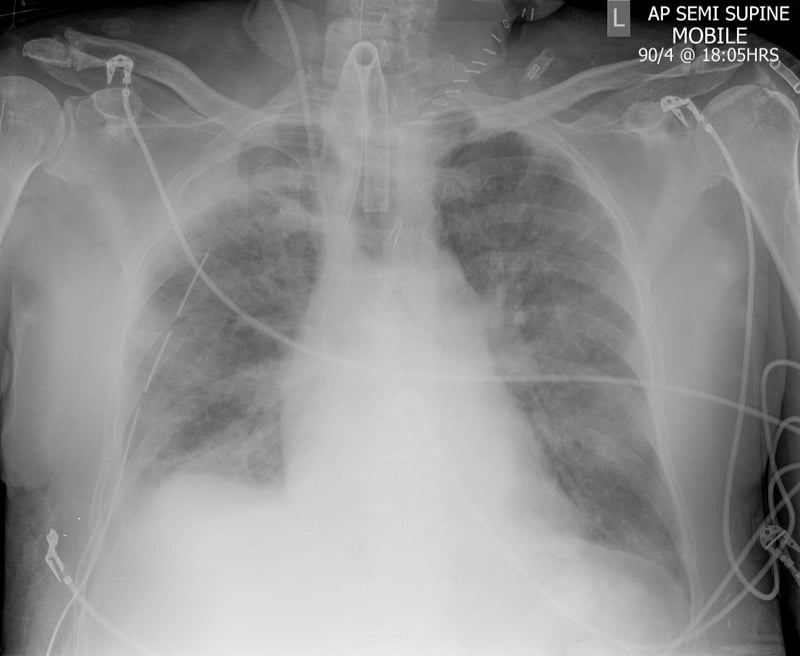Cardiac Lines — What is the CXR suggestive of?