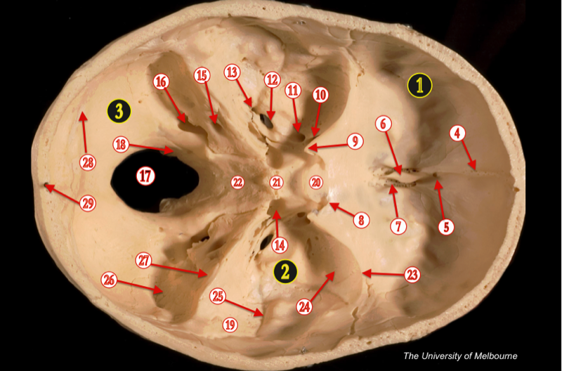 Skull Vault — MRCS Part B Anatomy