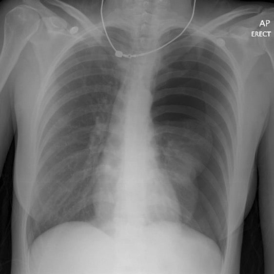 Pneumothorax — MRCS Part B Surgical pathology