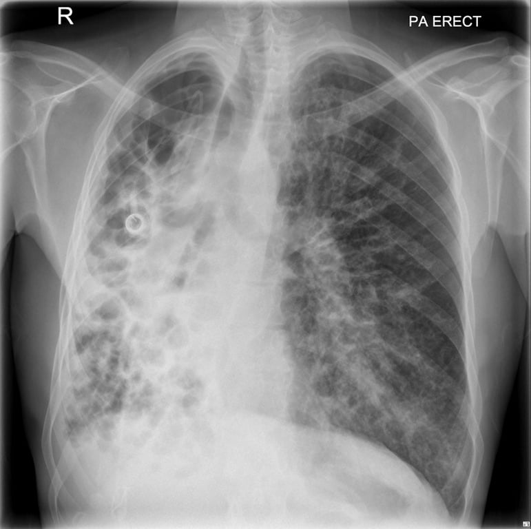 Airway — What does the CXR show?