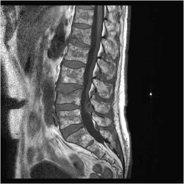 Haematology — The admitting emergency doctor has requested an MRI lumbar spine as she is concerned about