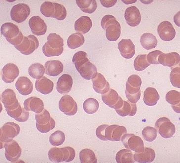 Haematology — A blood film from the same patient is shown. What does it demonstrate?