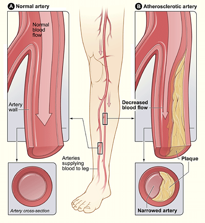 Peripheral Vascular Disease — MRCS Part B Surgical pathology