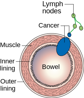 Colonic Carcinoma — MRCS Part B Surgical pathology