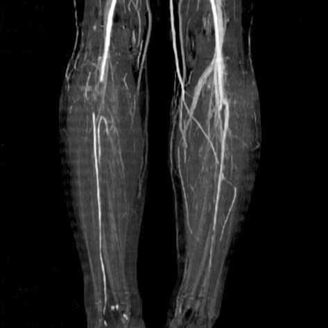 Peripheral Vascular Disease — What does the study show?