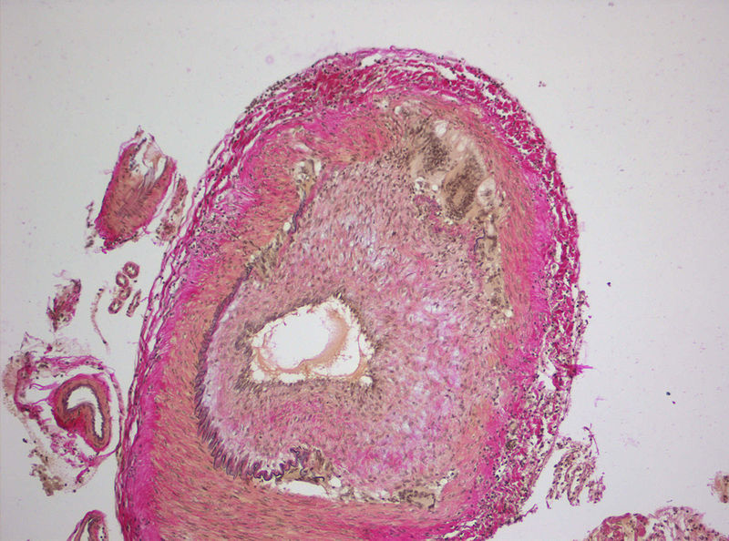 Temporal Arteritis — MRCS Part B Surgical pathology