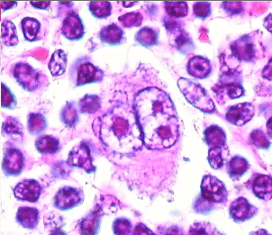 Haematology — A 23 year old lady is referred into your clinic by the haematologists with hepatosplenomeg
