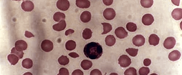 Anaemia — MRCS Part B Surgical pathology