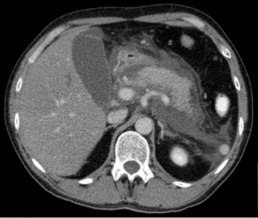 Pancreatitis — What are the causes of acute pancreatitis?