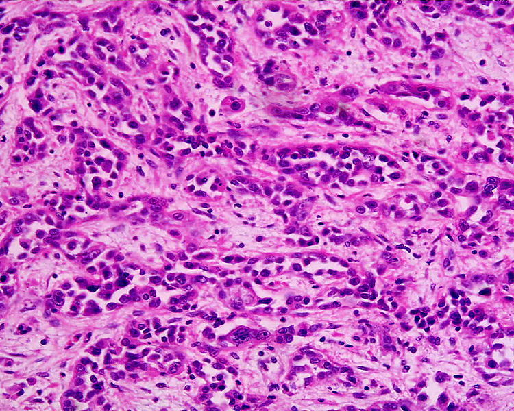 Stomach Carcinoma — The patient undergoes an OGD and biopsy. What does the biopsy film demonstrate?