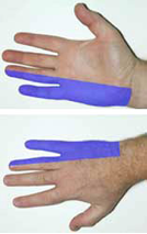 Ulnar — Given the examination features described and the area of sensation affected demonstrated a