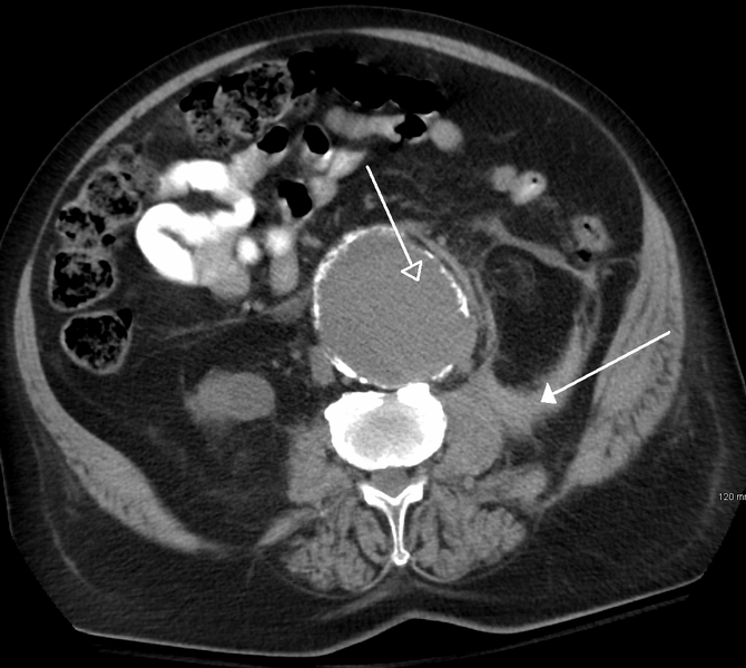 Aneurysm — What does the CT scan show?
