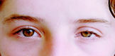 Cranial Nerves Eye — Describe what you see on general inspection