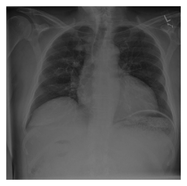 Stomach Carcinoma — The SHO has requested chest and abdominal films What do they show?