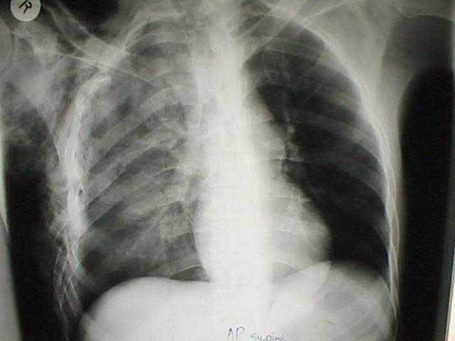 Pneumothorax — In a patient with a likely right-sided flail segment what does the above radiograph show?