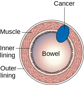 Colonic Carcinoma — MRCS Part B Surgical pathology