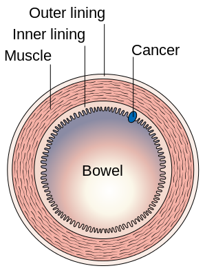 Colonic Carcinoma — MRCS Part B Surgical pathology
