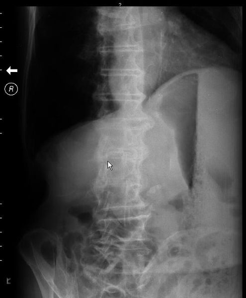 Stomach Carcinoma — The SHO has requested chest and abdominal films What do they show?