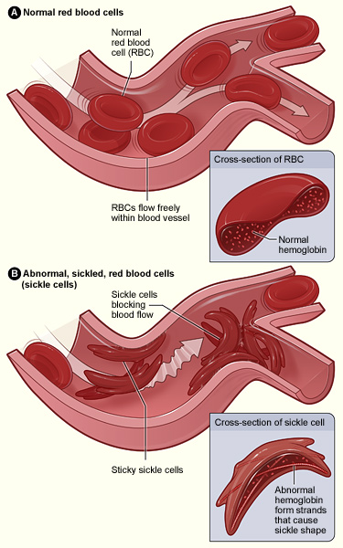 Anaemia — What conditions pre-dispose sickle cell patients to vaso-occlusive crises?