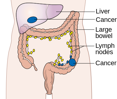 Colonic Carcinoma — MRCS Part B Surgical pathology
