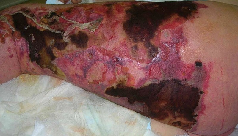 Micro 1 — How would you identify a patient with necrotising fasciitis?