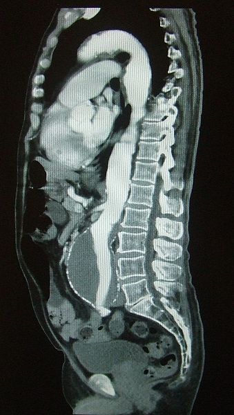Aneurysm — What does the CT scan show?