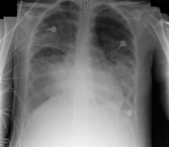 Pancreatitis — What is the likely diagnosis?