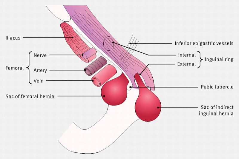 Femoral Region — MRCS Part B Anatomy