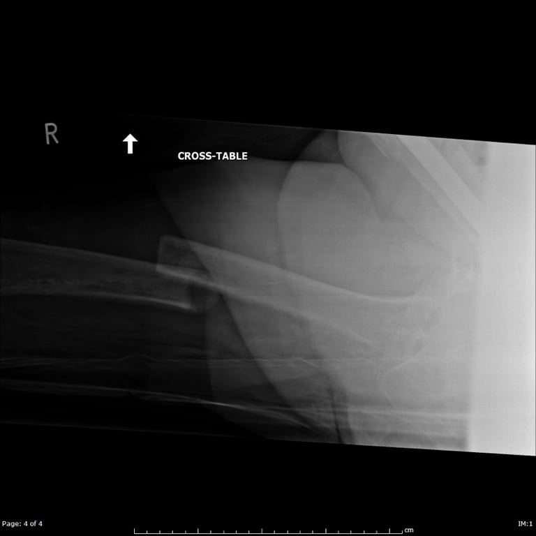 Shock 1 — The patient is stabilised and secondary surgery is performed including radiographs of her 