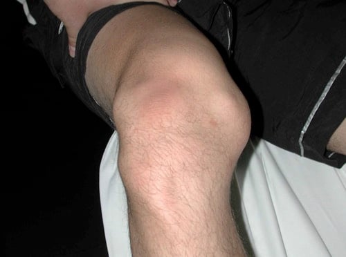 Popliteal Fossa — MRCS Part B Anatomy