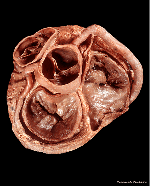 Heart Valve Anatomy