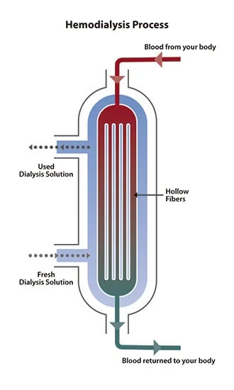 Hemo Dialysis, photo 2